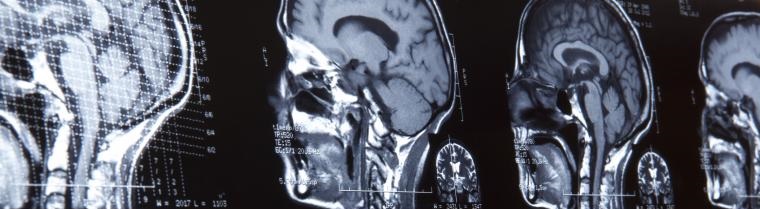 Brain Injury Attorney